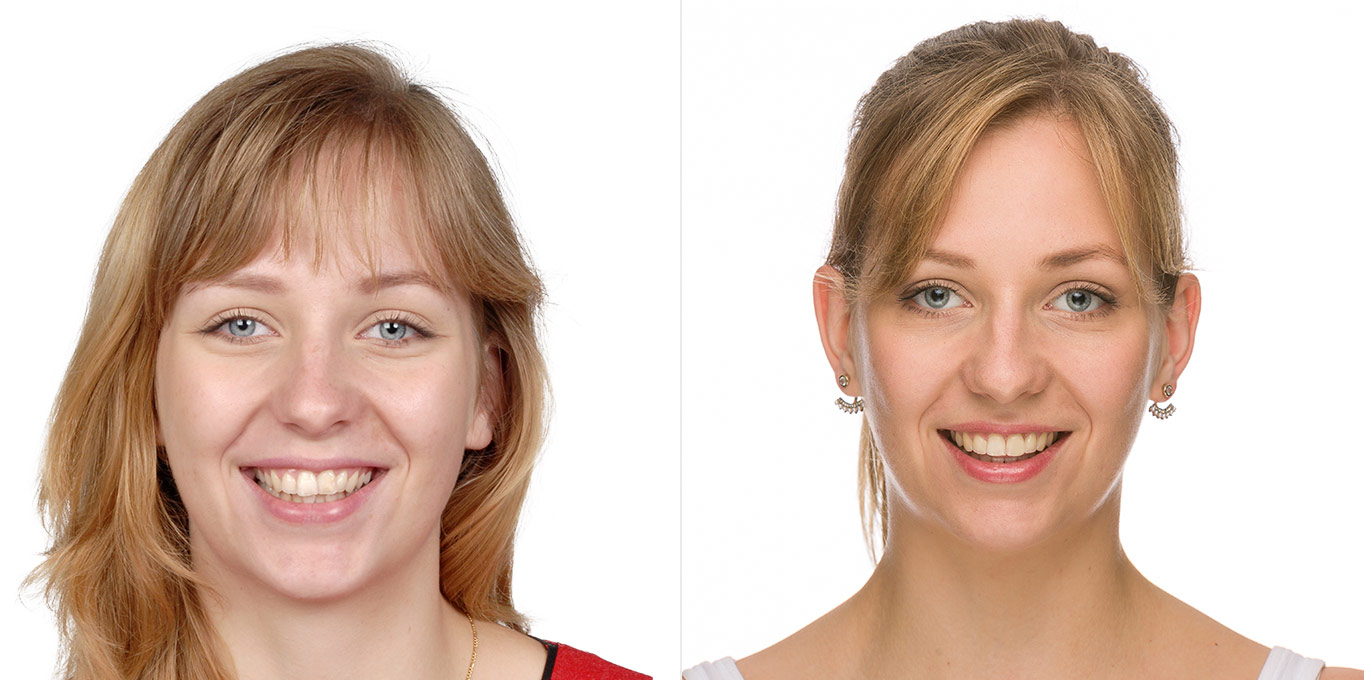 Dr. Töpfer Erwachsene Frau Vorher Nachher Bild Privatpraxis Wiesbaden