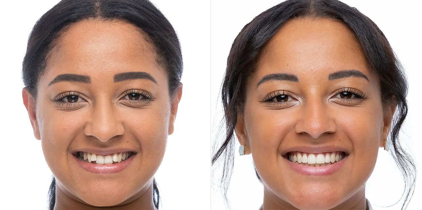 Dr. Töpfer Erwachsene Frau Vorher Nachher Bild Privatpraxis Wiesbaden